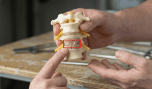 artrodesis cervical