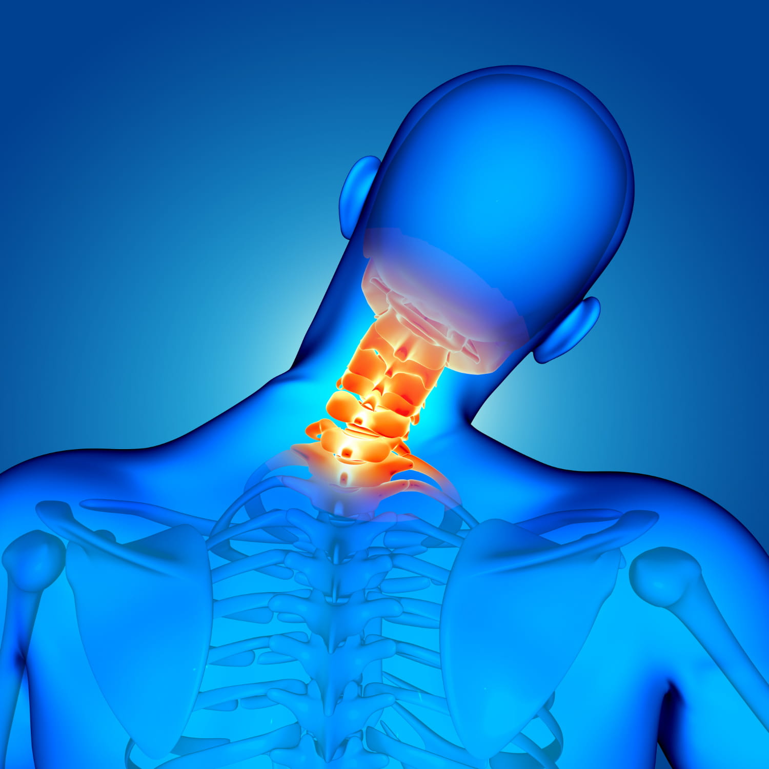 artrodesis cervical vs protesis cervical