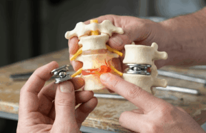 prótesis cervical